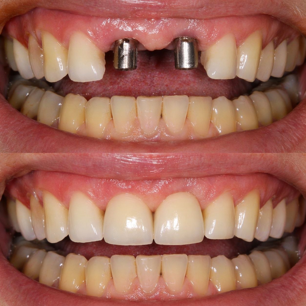 Before and after dental implants treatment in Kalyanpur Lucknow