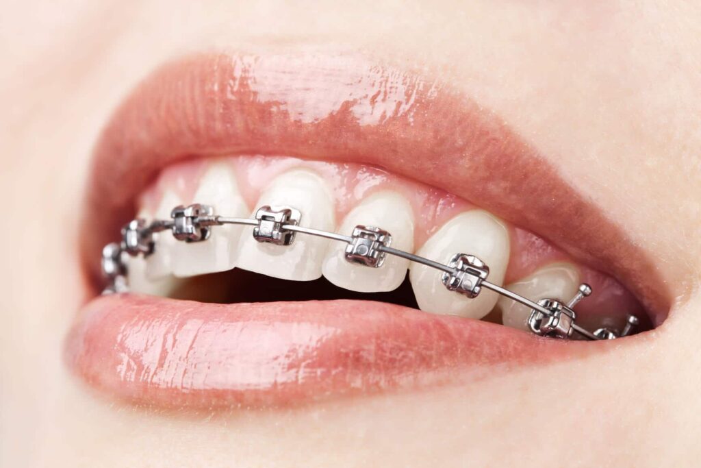 Braces treatment in Lucknow at Truemax Dental Clinic