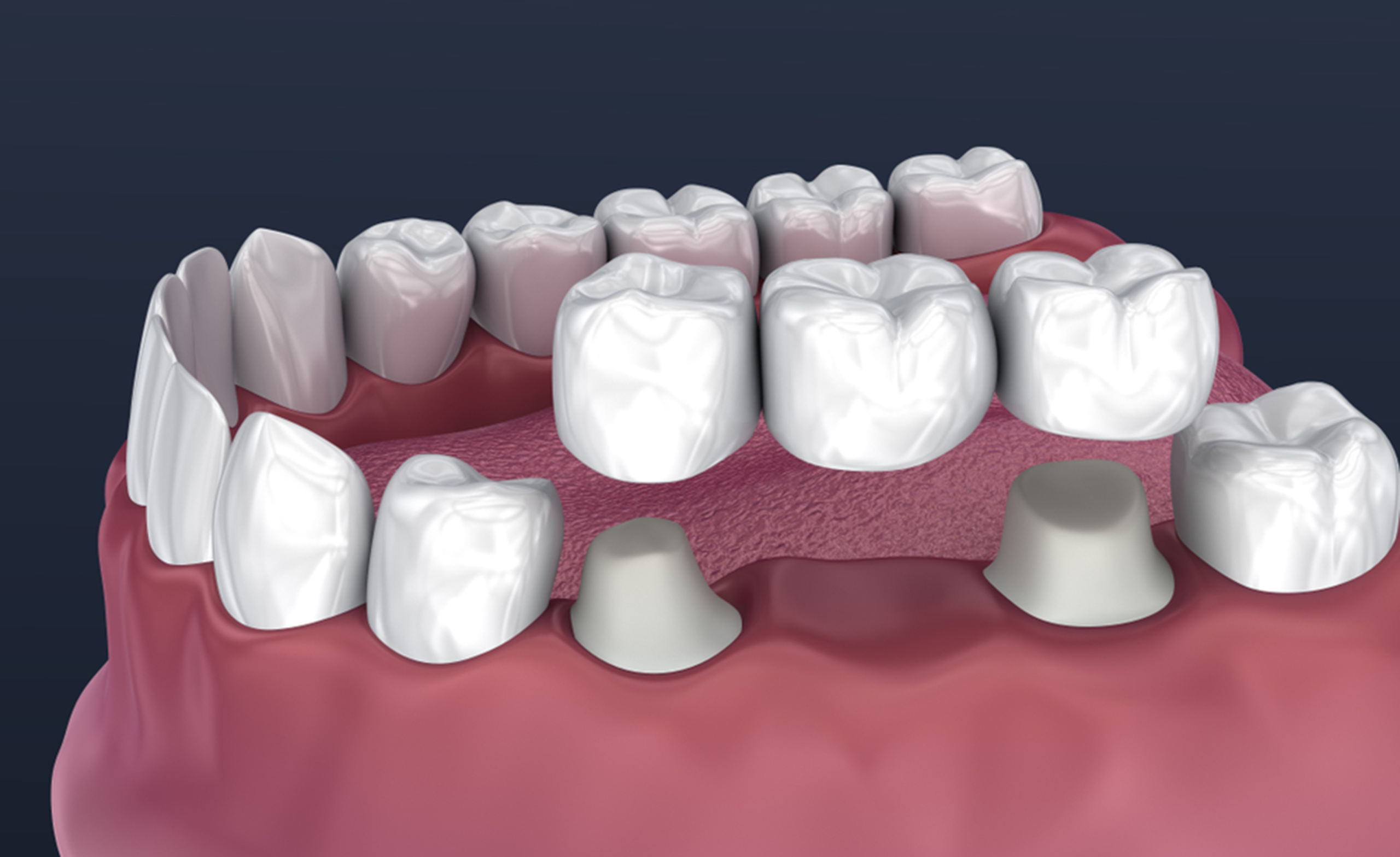 Dental crowns and bridges treatment in Lucknow