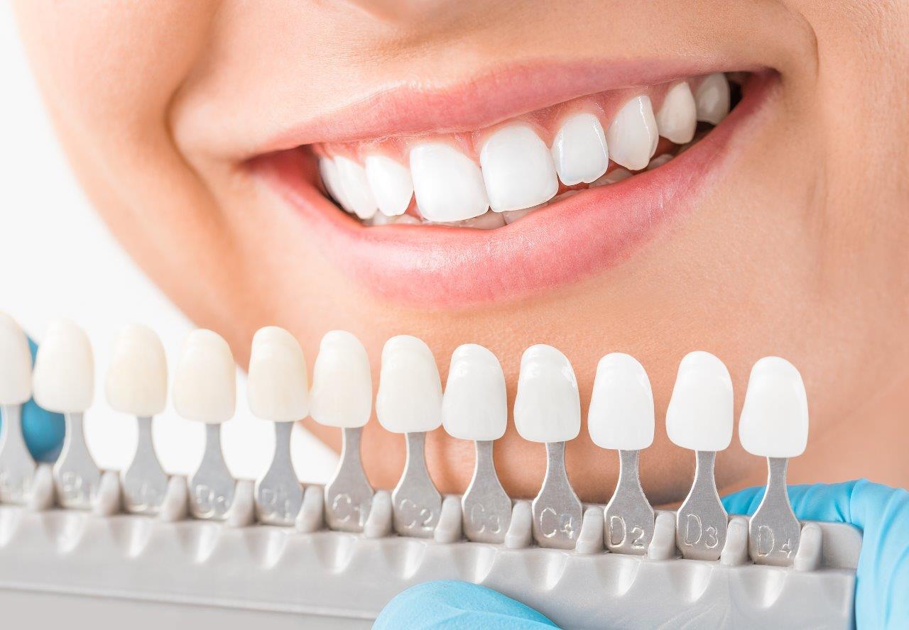 Dental Veneers in Lucknow at Truemax Dental Clinic