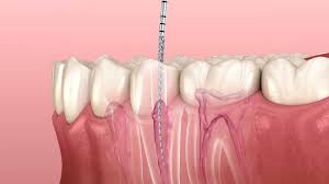 Root canal treatment in Lucknow at Truemax Dental Clinic by Dr Rehana