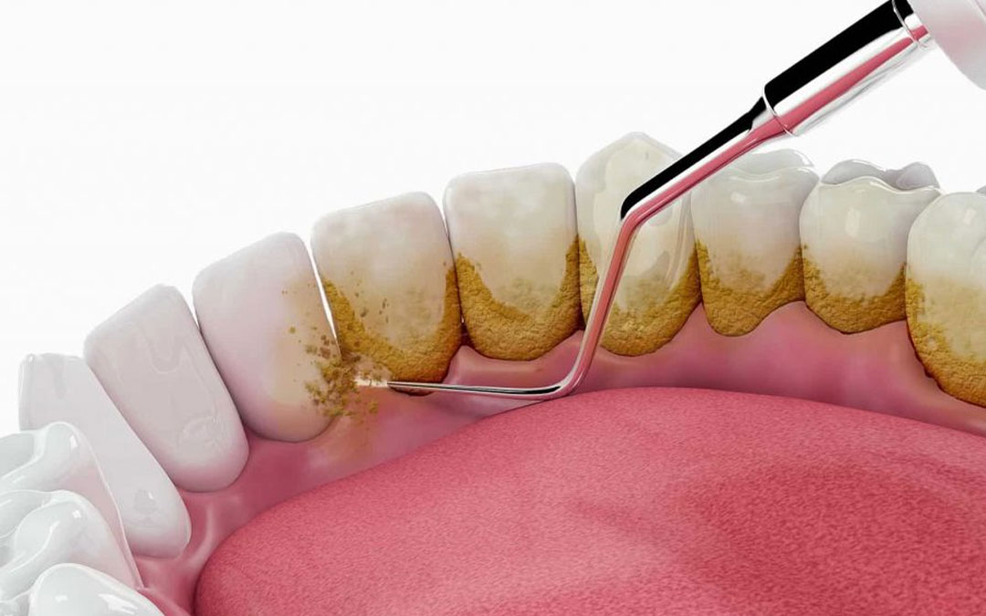 Teeth cleaning and scaling treatment in Lucknow at Truemax Dental Clinic