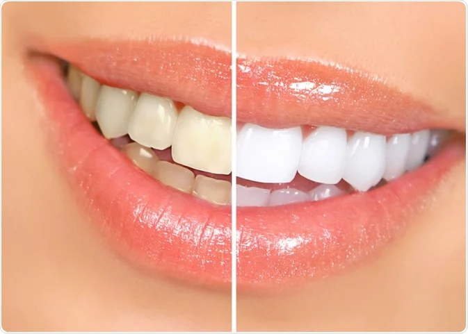 Teeth Whitening in Lucknow at Truemax Dental Clinic