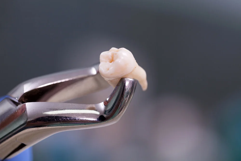 Tooth Extraction in Lucknow at Truemax Dental Clinic