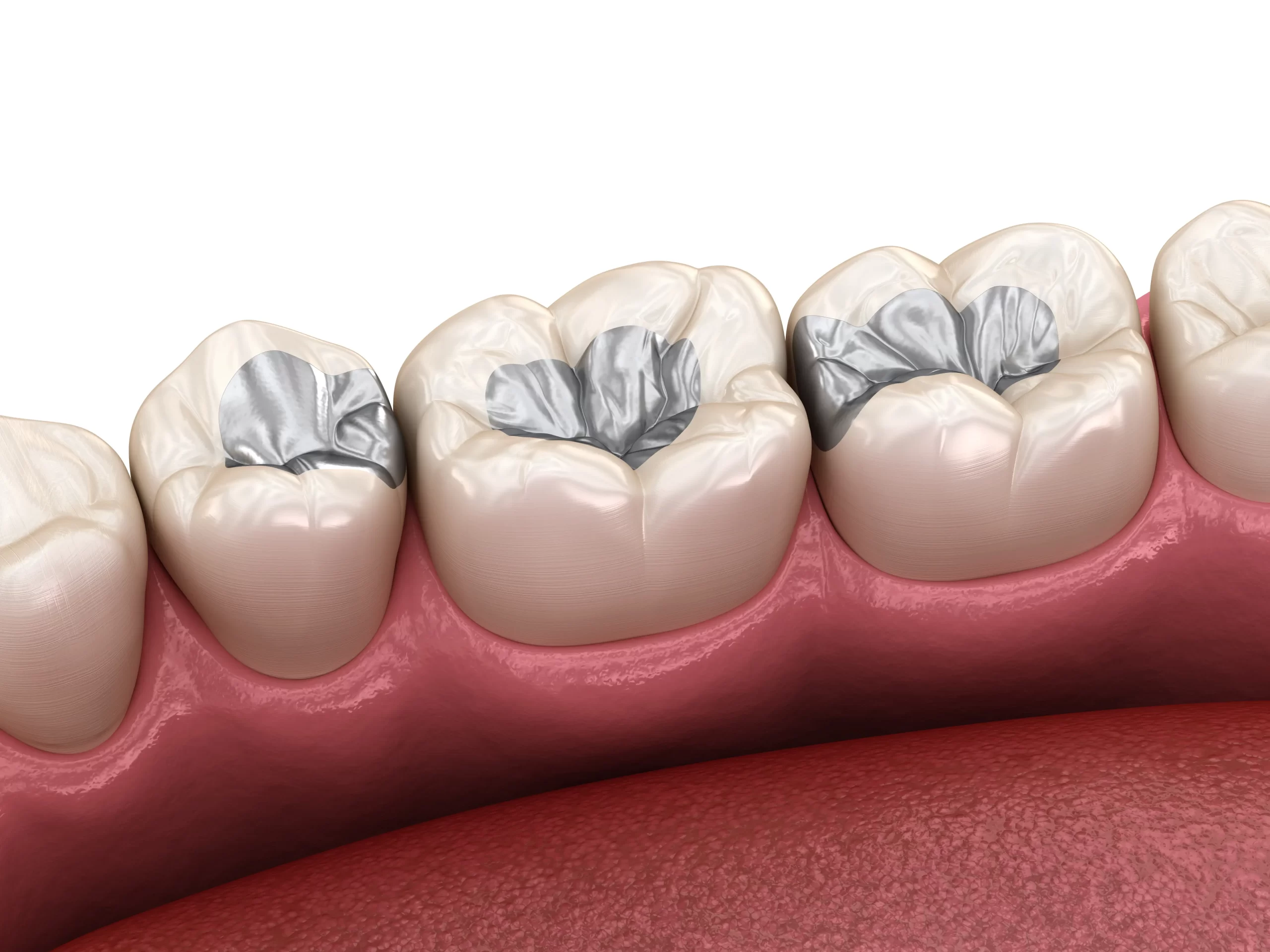 Tooth Filling Treatment in Lucknow at Truemax Dental Clinic