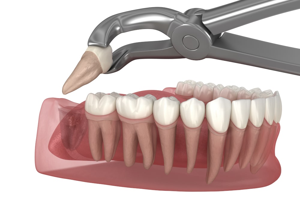 Wisdom Tooth Removal in Lucknow at Truemax Dental Clinic