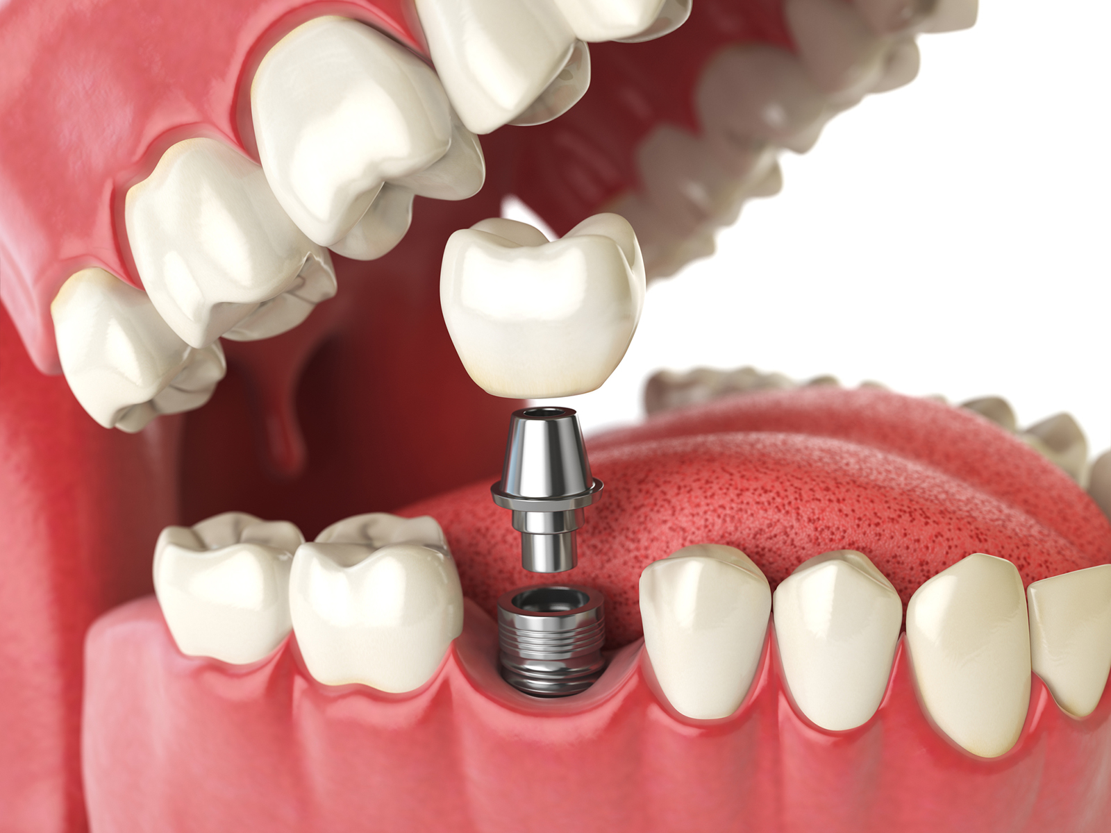 Abutment placement
