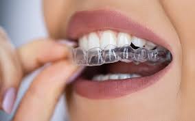 Clear aligners treatment in Lucknow at Truemax Dental Clinic
