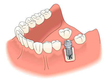 Dental Implants in Kalyanpur Lucknow at Truemax Dental Clinic