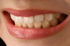 Natural looking dental implants