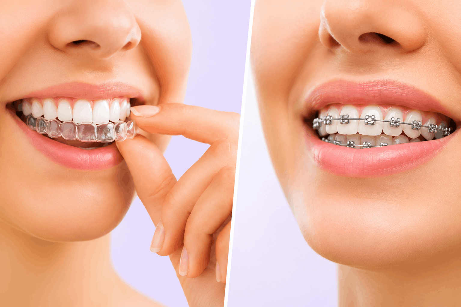 Clear Aligners vs Braces in Lucknow