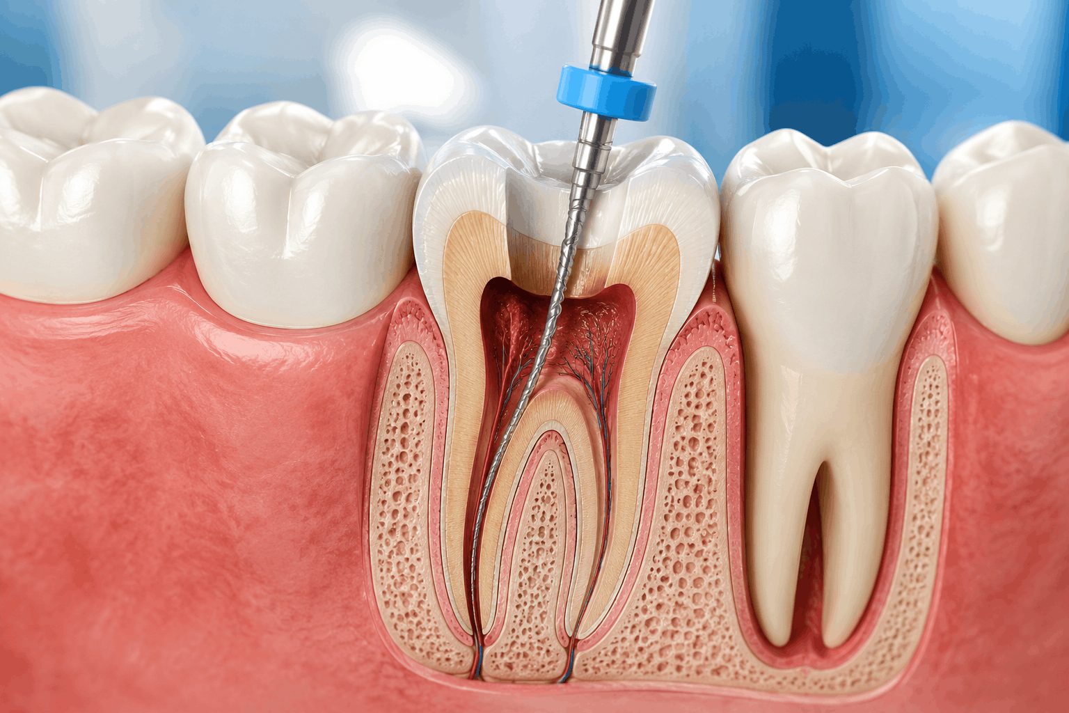 Root Canal Treatment in Lucknow